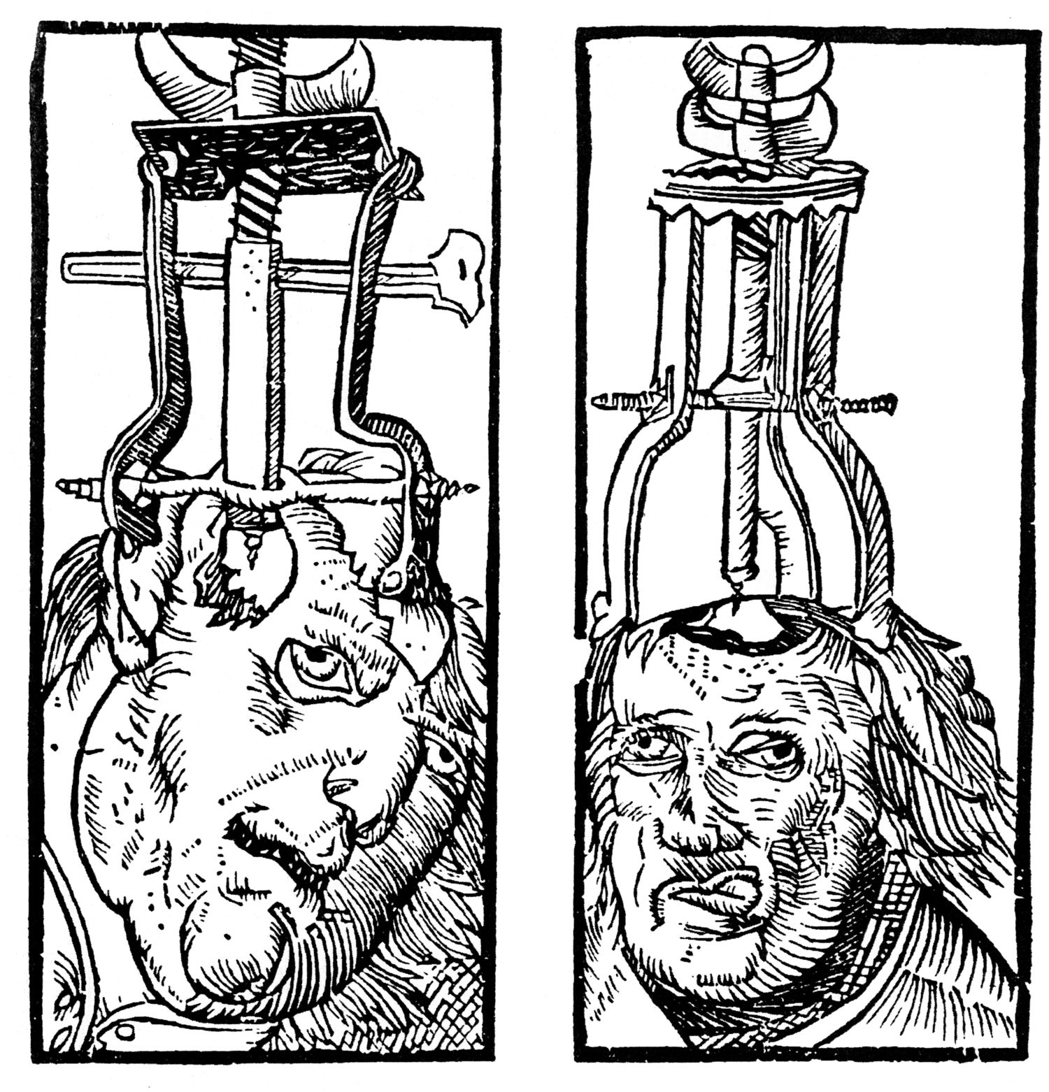 trepanacija lobanje
