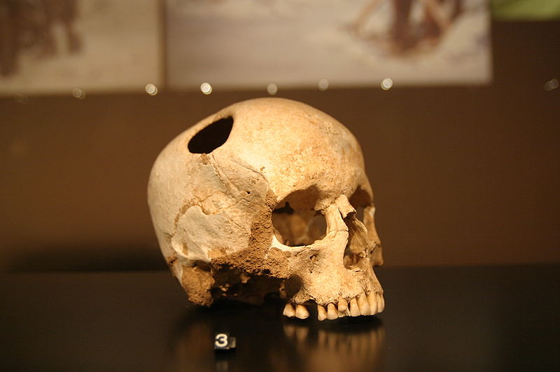 Trepanirana lobanja, foto Muzej Vojvodine